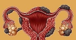 'Heart-breaking' study of endometriosis retracted after 7 years