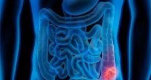 Colorectal cancer prevention: BMJ evidence review of 80 meta-analyses