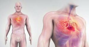 Polypill plus aspirin reduces incidence of cardiovascular events by 31% — TIPS-3