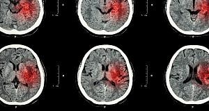 A two-week 'window of opportunity' for best recovery after stroke