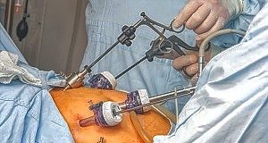 Bariatric surgery significantly cuts cancer risk in severely obese NAFLD patients