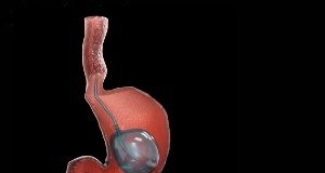 AGA: New clinical practice guidelines on IGBs for weight loss