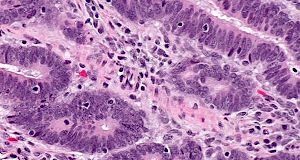 Immunotherapy combination shows early promise in glioblastoma