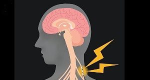 Vagus nerve stimulation: A potential new treatment for ischaemic stroke