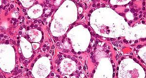 Annual screening for ovarian cancer does not save lives — Large UK trial