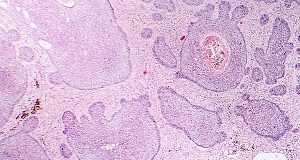 Histone deacetylase inhibitor gel efficacious for basal cell carcinoma — Phase II trial