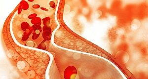 Twice-yearly inclisiran injections as alternative to daily statins in NHS plan