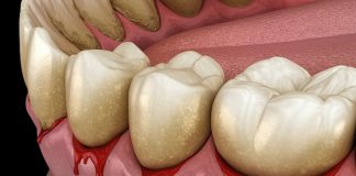 Dental meta-analysis: The best, worst and unproven oral hygiene tools