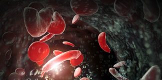 NHS England to offer breakthrough treatment for sickle cell disease