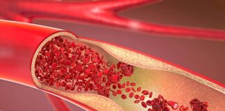 Coronary plaque found in more than half of HIV cases – COCOMO study