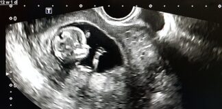 Early autism signs can detected by routine prenatal ultrasound – Israeli study