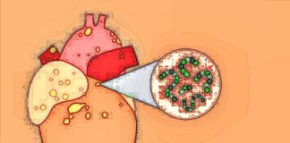 Dentistry: No endocarditis increase with end to antibiotic prophylaxis – Karolinska Institutet