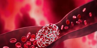 Blood clot risk still high months after COVID – Bristol University study