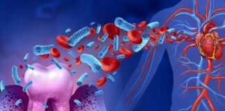 Gum infection a risk factor for heart arrhythmia – Japanese study