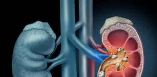 Standard kidney stone treatment may not be effective – Swiss study