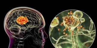 Silent epidemic of deadly fungal infections in Africa