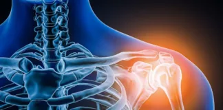 Common shoulder procedure of no benefit – Norwegian study
