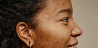 New UK rules for treatment with acne drug