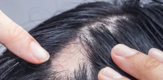 Alopecia surge after Covid – large South Korean study