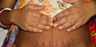 SA’s 'too high' Caesarean birth rate must be reversed