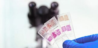 Ultrasound cancer screening less accurate in black women – US study