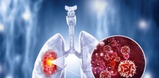 FDA approves chemo-free treatment for lung cancer